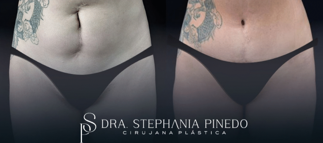 cicatriz vertical en horizontal con abdominoplastia en Bogotá Dra Pinedo