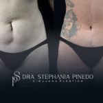 cicatriz vertical en horizontal con abdominoplastia en Bogotá Dra Pinedo