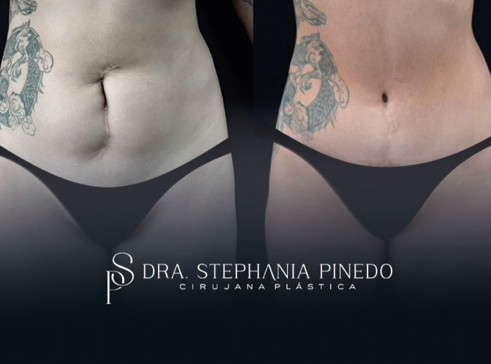 cicatriz vertical en horizontal con abdominoplastia en Bogotá Dra Pinedo