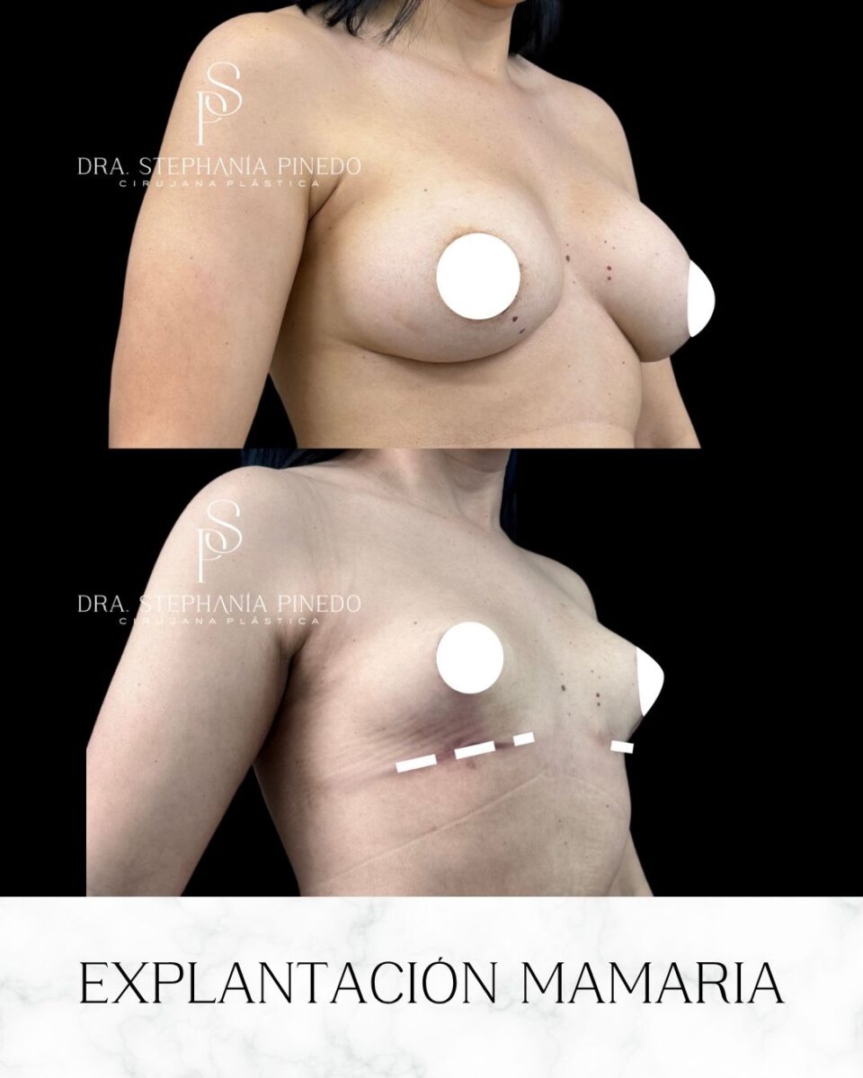 Before and after breast lift with fat transfer results Bogota