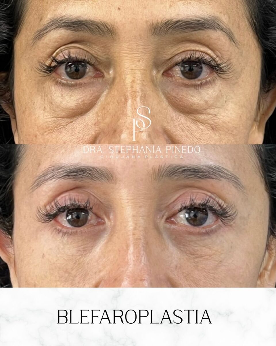 Resultado de cirugía de párpados en Bogotá - Mirada descansada y natural.