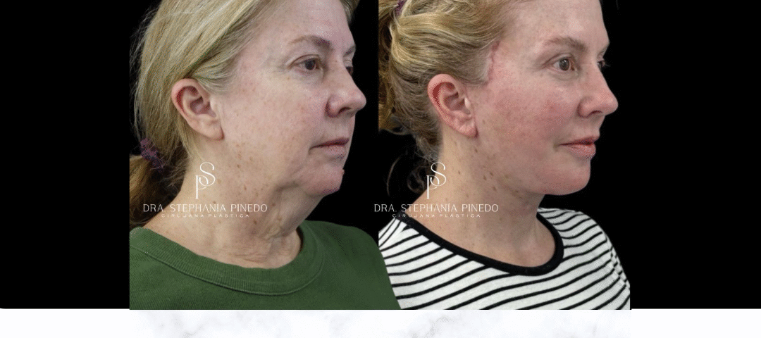 Before and after Deep Plane Facelift for Ozempic Face patient in Bogota by Dr. Stephania Pinedo.