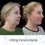 Before and after Deep Plane Facelift for Ozempic Face patient in Bogota by Dr. Stephania Pinedo.