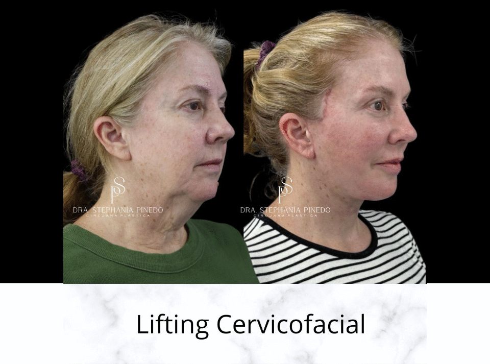 Before and after Deep Plane Facelift for Ozempic Face patient in Bogota by Dr. Stephania Pinedo.