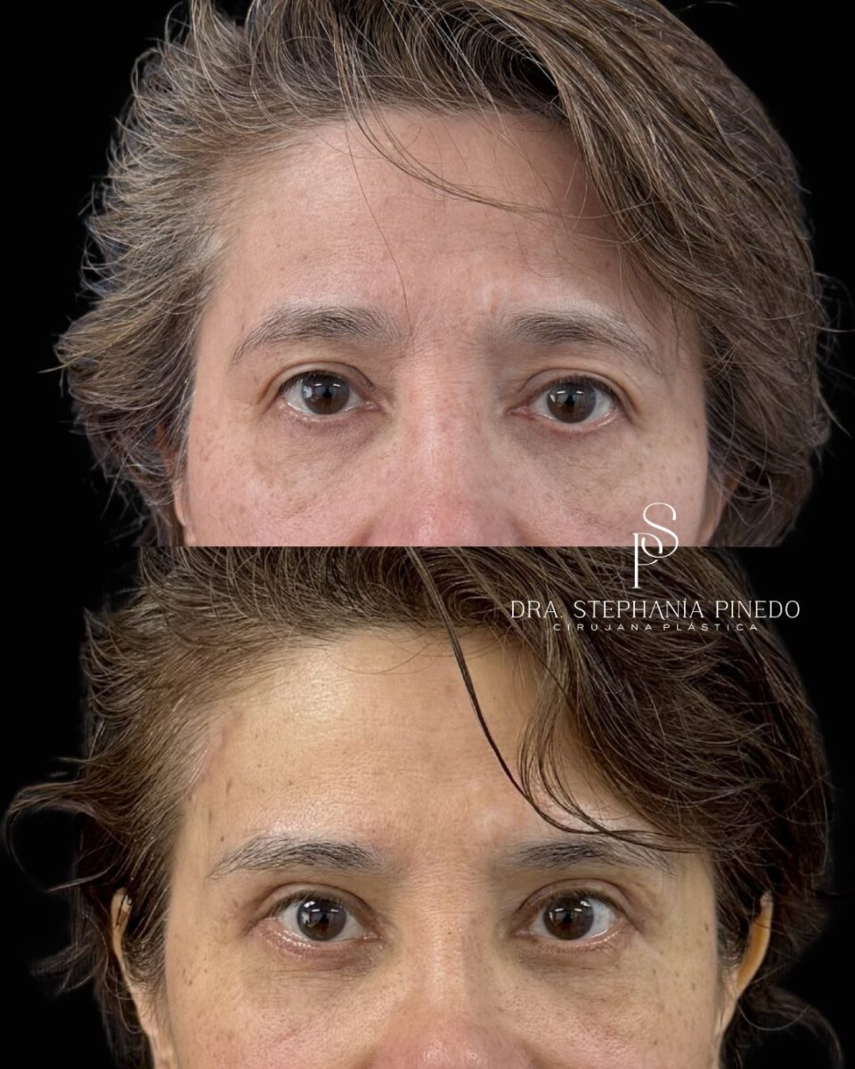 Blepharoplasty and brow lift results in Bogota to complement facial rejuvenation.