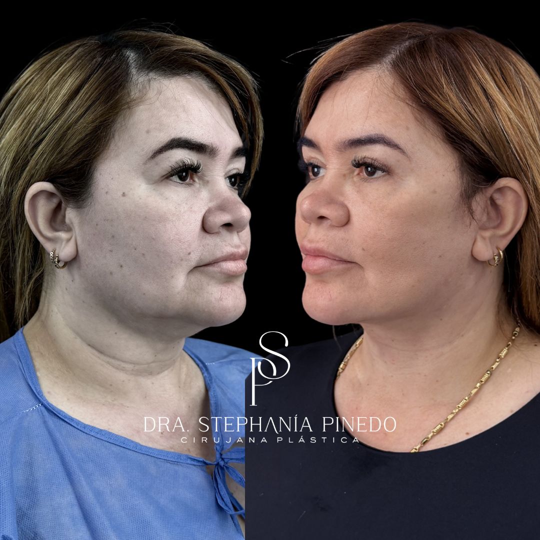 Definición de ángulo mandibular y cuello con lifting cervicofacial en Colombia.
