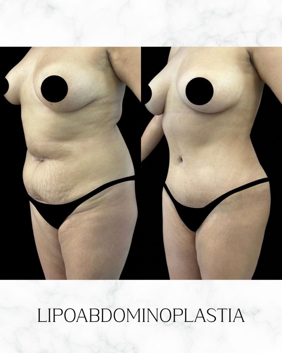 Before and after tummy tuck results in Bogota showing natural navel and hourglass silhouette