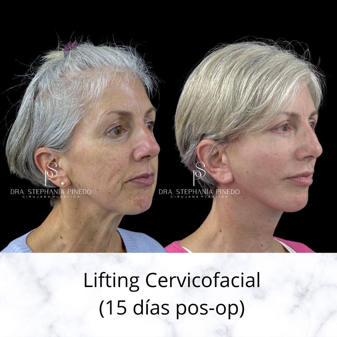 Profile view of neck lift and jawline definition after massive weight loss.
