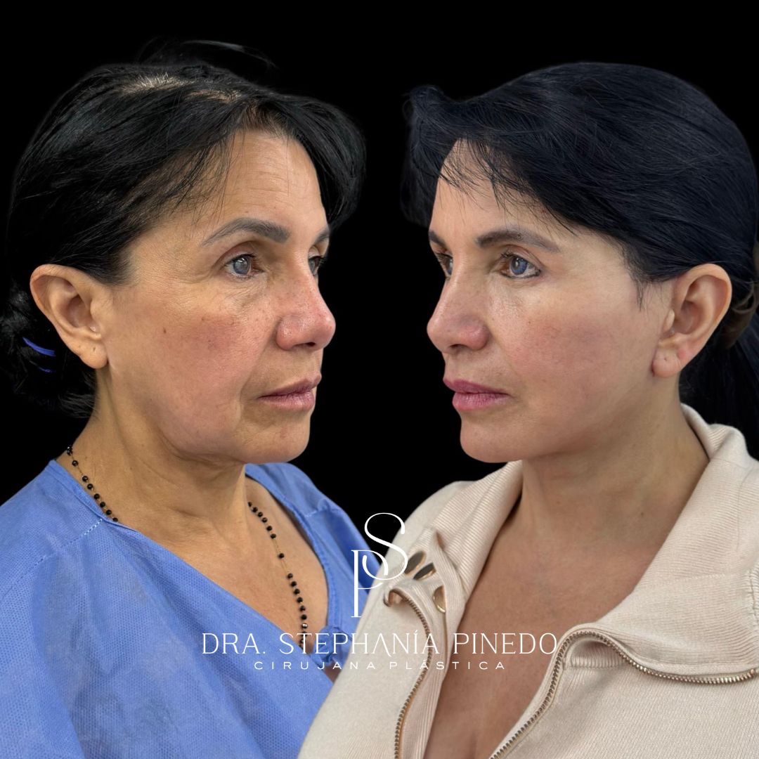 Resultados naturales de lifting facial profundo en Colombia
